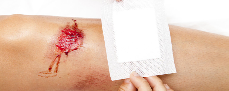 Wound treatment