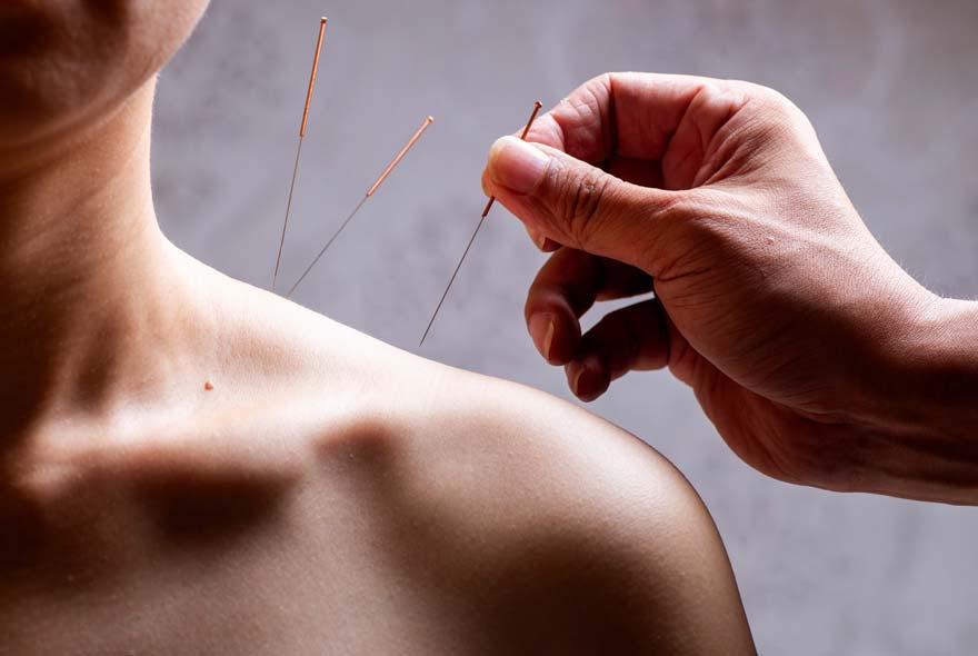 Someone using Acupuncture Needles on a woman