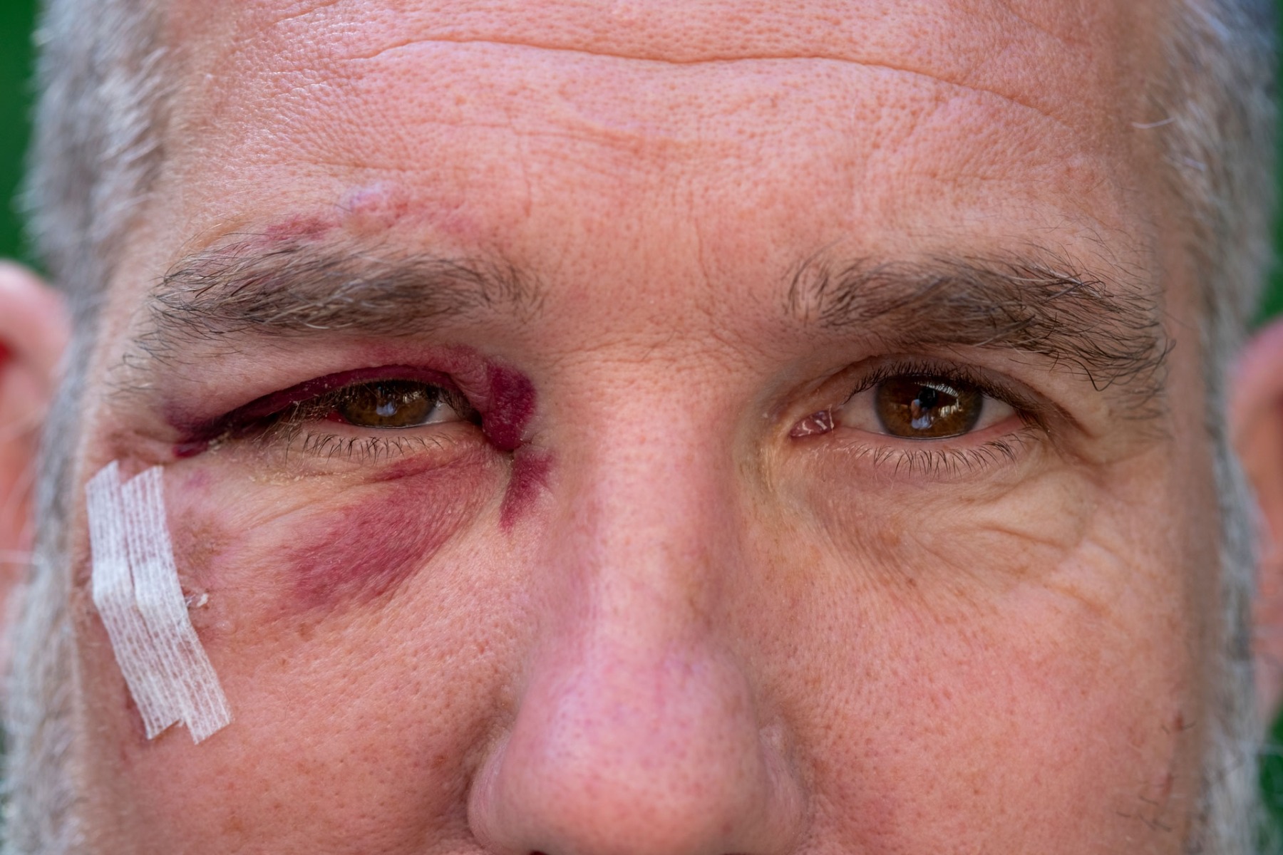 Close-up of man with black eye wound Close-up of man with black eye wound