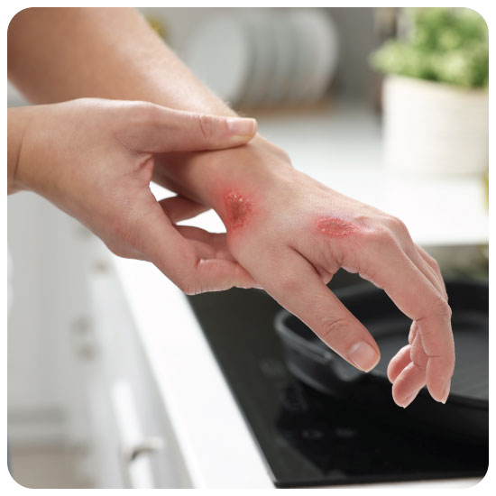 Steroplast Paraffin Gauze sterile dressing