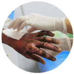 Doctor treating burn on patients hand