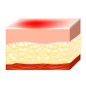 Illustrations depicting how deep a first degree burn is on the skin