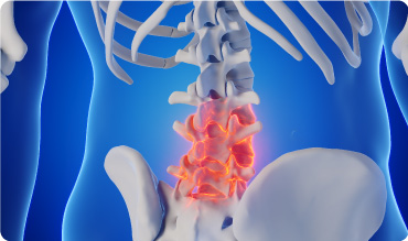 Illustration showing an x-ray view of inflammation on a spine