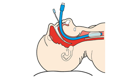 Laryngeal Tube