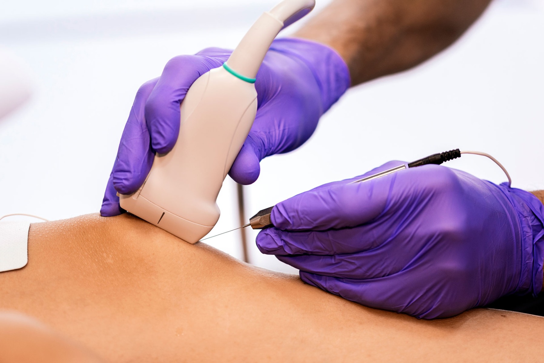 Performing acupuncture