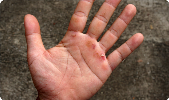 Ruptured Blister on Hand