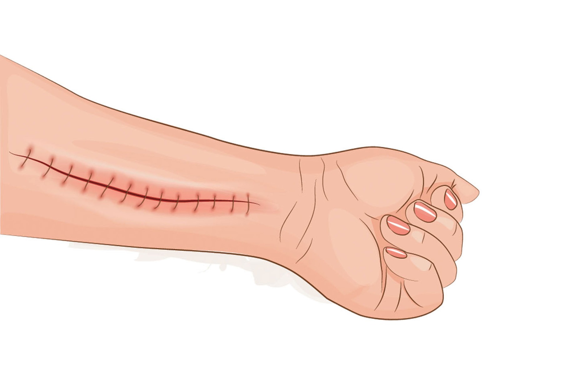 Arm with stitches wound illustration