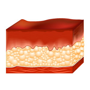 Illustrations depicting how deep a third degree burn is on the skin