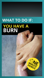 What to do if you have a burn