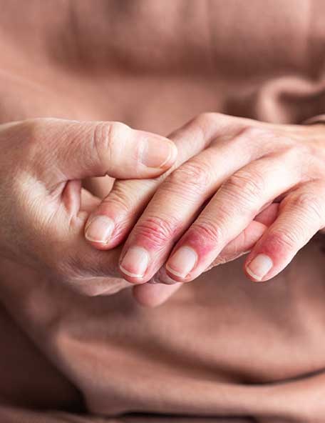 Woman hands with dermatitis
