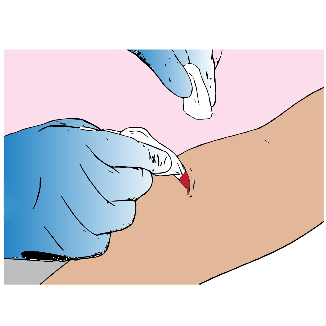 Gauze packed in wound