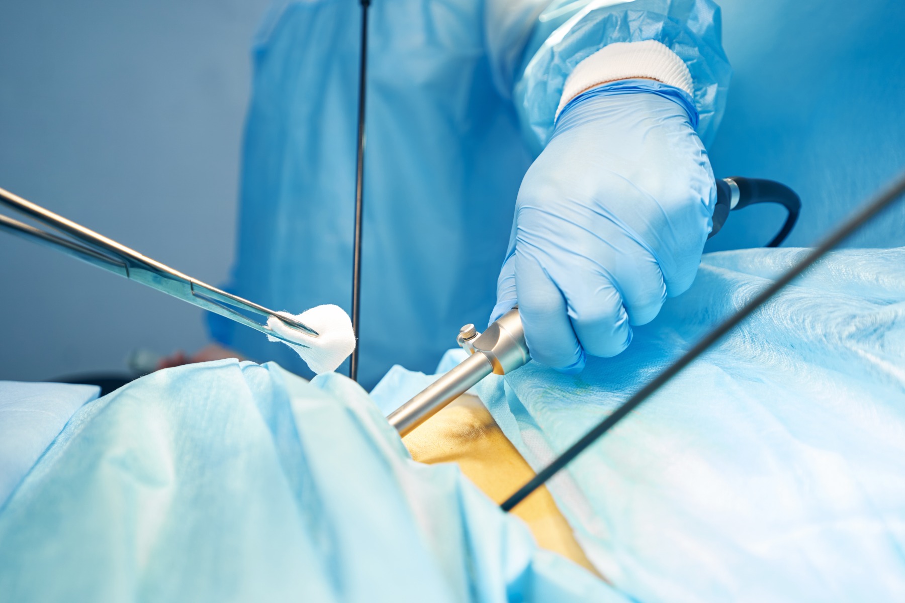 Gauze in surgical forceps moving to abdomen incision during operation Gauze in surgical forceps moving to abdomen incision during operation