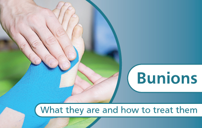 Bunions - What they are and how to treat them 